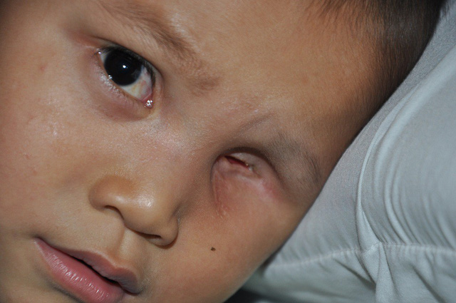 rơi nước mắt câu hỏi mắt con đâu của cậu bé 3 tuổi phải khoét bỏ bên mắt 