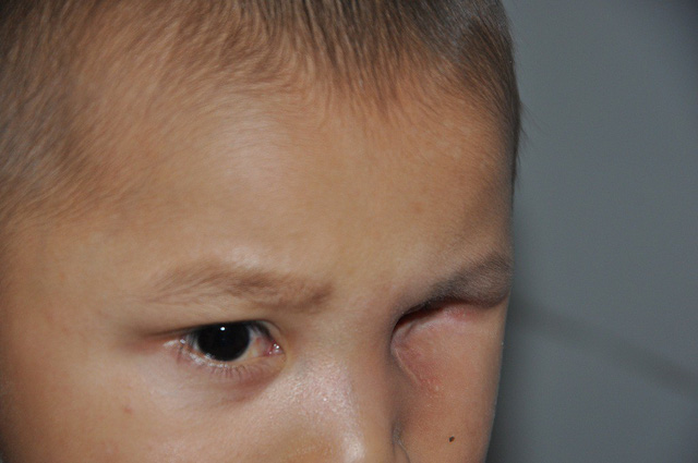 rơi nước mắt câu hỏi mắt con đâu của cậu bé 3 tuổi phải khoét bỏ bên mắt 